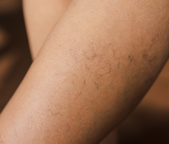 Які шанси успадкувати варикоз від батьків?