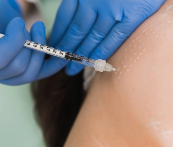 МЕЗОТЕРАПІЯ: ЩО ЦЕ ТАКЕ, ЕФЕКТ ВІД ПРОЦЕДУРИ І ЯК ЧАСТО МОЖНА РОБИТИ?