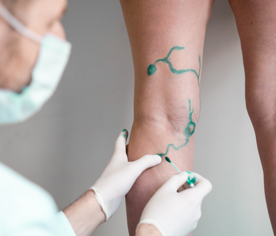 ЯК ЛІКУВАТИ ВАРИКОЗ?