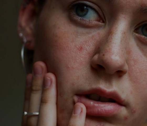 ВСЕ, ЩО ВИ ХОТІЛИ ЗНАТИ ПРО АКНЕ: ВИДИ, ПРИЧИНИ, СИМПТОМИ, ЛІКУВАННЯ