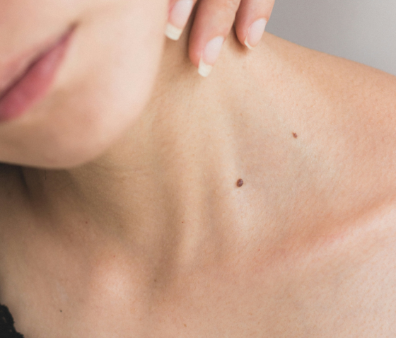 РОДИМКА ТА МЕЛАНОМА: ЯК ВІДРІЗНИТИ?