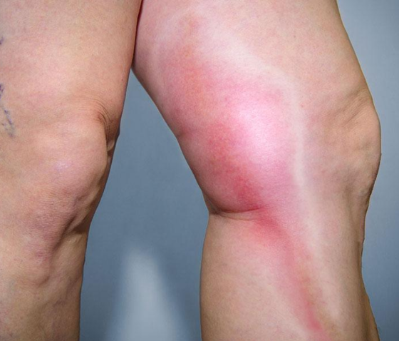 ЯК ЛІКУВАТИ ТРОМБОФЛЕБІТ?