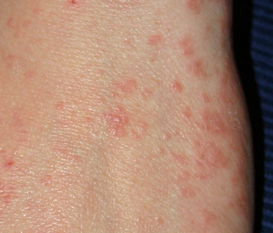 КОРОСТА: ЛІКУВАННЯ, ДІАГНОСТИКА, ПРОФІЛАКТИКА, СИМПТОМИ