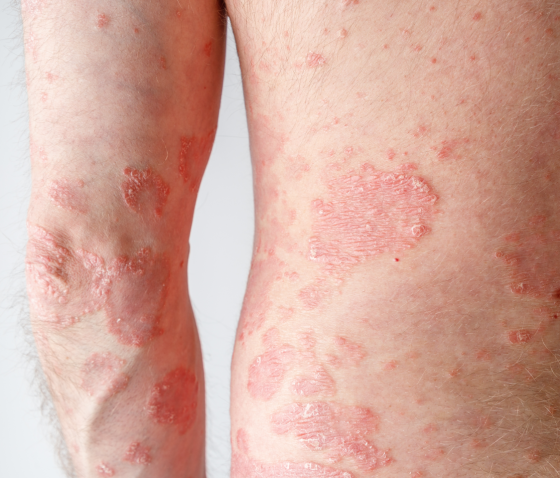 РОЖЕВИЙ ЛИШАЙ ЖИБЕРА: СИМПТОМИ, ПРИЧИНИ, ЛІКУВАННЯ