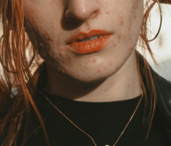 ЯК ПОЗБУТИСЯ ПРИЩІВ НАЗАВЖДИ?