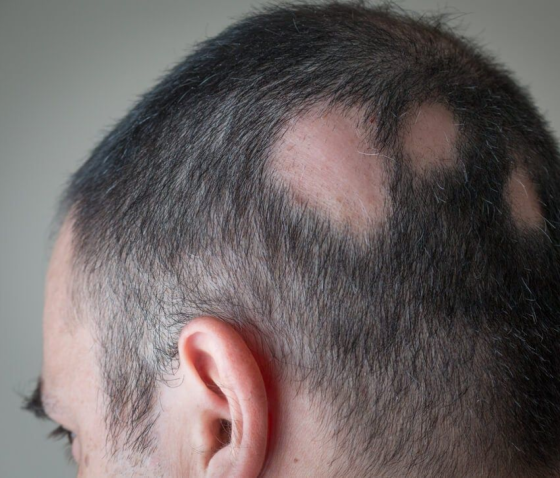 ВОГНИЩЕВА АЛОПЕЦІЯ: ДІАГНОСТИКА ТА ЛІКУВАННЯ У ЧОЛОВІКІВ ТА ЖІНОК