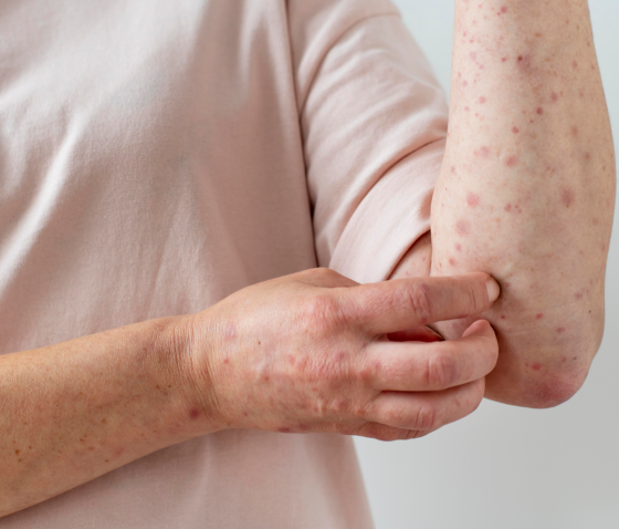 ПІОДЕРМІЯ: ЇЇ РІЗНОВИДИ ТА СПОСОБИ ЛІКУВАННЯ