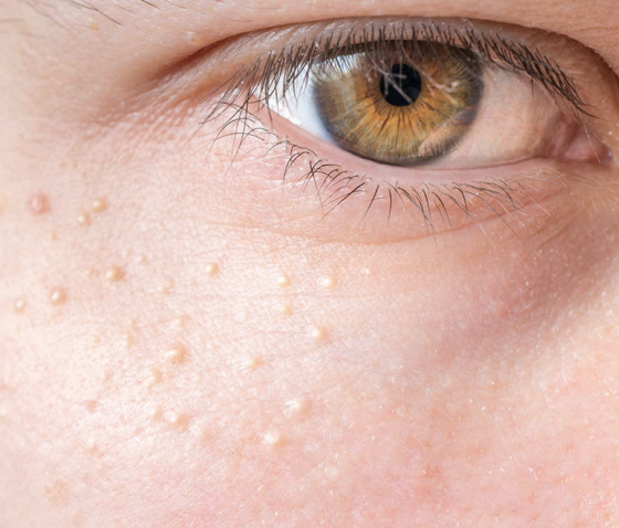 МІЛІУМИ: СИМПТОМИ ТА ПРИЧИНИ ПОЯВИ